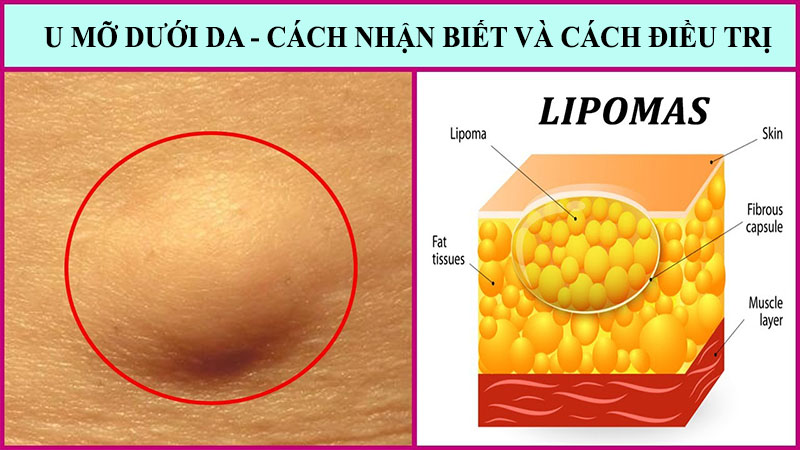 U mỡ - Hình ảnh minh họa